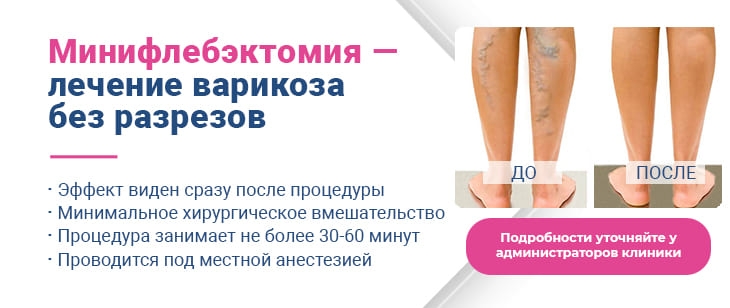 Минифлебэктомия
